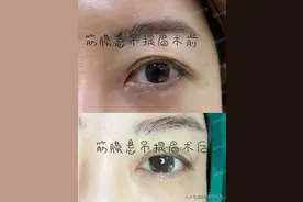 总结提眉手术大家问得最多的20个问题，一起来看看图片