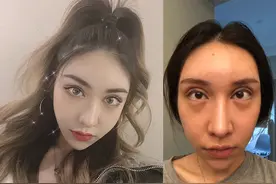 双眼皮做得好好的，为何患者不满意？遇到这种情况医生很冤枉？图片