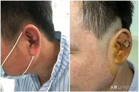 46岁男子耳朵上长“痘痘”？手挤针戳都不好，一查发现是“肿瘤”图片