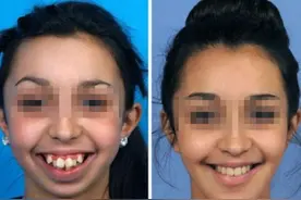 几岁左右做牙齿矫正比较好？这几个最佳时机，你抓住了吗？图片