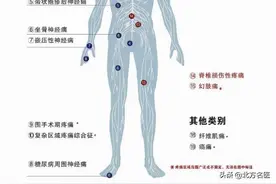 世界镇痛日 | 这三种最痛的疾病你经历过吗？图片