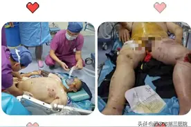 从ICU醒来 | 一例重型车祸伤救治始末图片