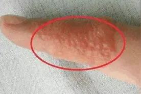 手上一旦出现“小水泡”，还发痒！提醒：是身体发出“求救”信号图片