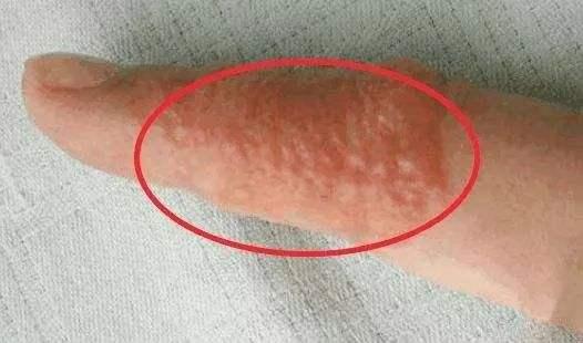 手指上起小红点很痒