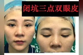 韩式微创三点双眼皮这么好，为什么竟然有医生不愿意做？图片