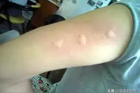 被蚊虫叮咬后瘙痒难耐，教你几招，几秒快速止痒，不起疙瘩图片