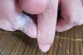 误打误撞，脚气病居然花2元钱就好，你也可以试试图片