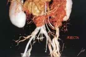 南大二附院王世知博士团队成功治愈一例盆腔淤血综合症患者图片