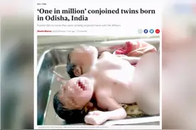 印度女子生下连体双胞胎，2头3手共用身体，产前不知胎儿异常图片