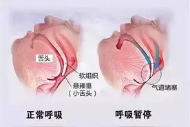 【世界睡眠日系列科普之四】手术刀也能治打鼾？图片