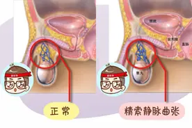 男性精索静脉曲张的形成及日常调理图片