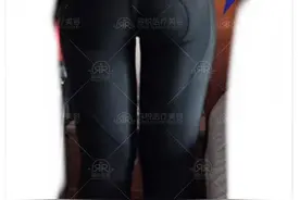 整形医生蒋亚楠介绍：分分钟搞定大象腿 吸脂2个月后变细腿精图片