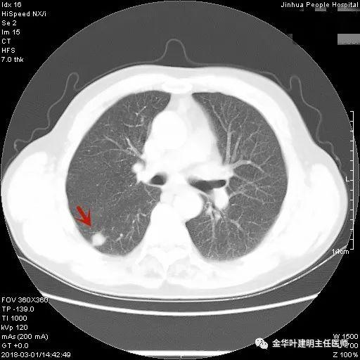 叶建明谈结节：检查发现肺实性结节怎么办？个人版实用指南