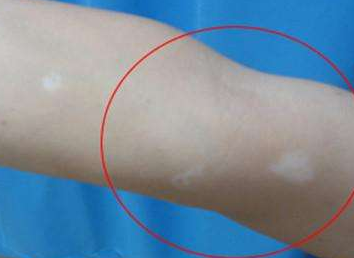 脱毛膏引起毛周角化