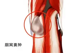膝盖后长出个“鸡蛋”，“钥匙孔手术”轻松摘除图片