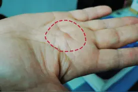 手指疼，指根还鼓了个包，是骨质增生还是筋变粗了？医生全面解答图片