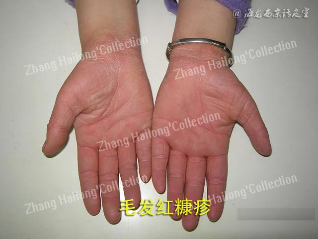 艾滋会引起毛囊角化症