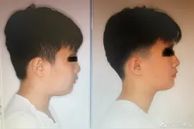 如何避免牙齿矫正的“隐性消费”？超详细费用介绍，看到就是省钱图片