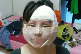 整容高达200次，公开质疑李小璐博眼球，为了变美"断骨"成残疾图片