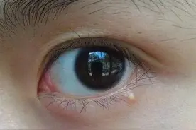 长了脂肪粒怎么办？不能用手抠也不能抓挠，教你真正的去除办法图片