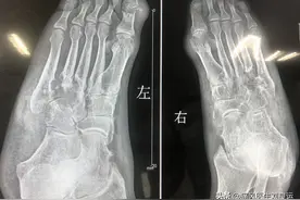 五年痛风三年长石头，他像挤青春痘一样挤痛风石，这样做靠谱吗？图片