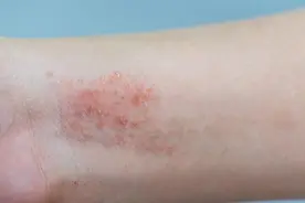 常见皮肤病的中医防治之——２湿疹图片