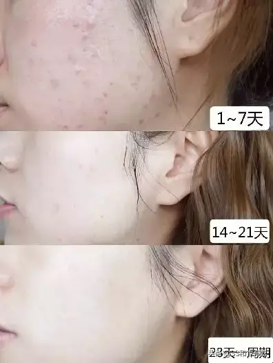 火爆INS的芝士皂，洗脸就像敷面膜，痘痘，黑头，螨虫全都消失了