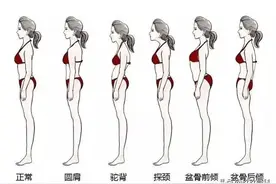 详解骨盆前倾及骨盆后倾，附康复训练方案图片