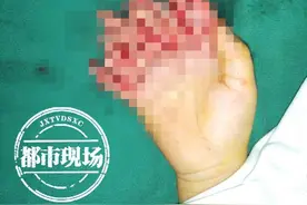 疼！妈妈一时疏忽，2岁男童手掌被绞肉机打成了“面条指”图片