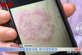 女子莫名染上顽疾，皮肤起红疹，竟是“撸猫”惹的祸图片