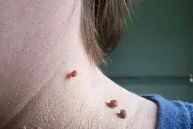 脖子上长了小肉粒，不疼也不痒痒，要怎么处理，能用手抠吗？图片