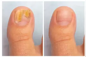 指甲变色是灰指甲？9种人易得！想治愈灰指甲，医生4招照着做图片