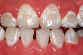 牙齿脱矿了怎么回事能治吗？#雅悦齿科#图片