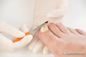 甲沟炎可以自愈吗图片