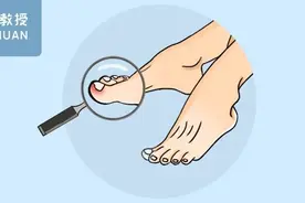 80%的人都经历过的指甲红肿疼痛，可能是这4个原因造成的图片