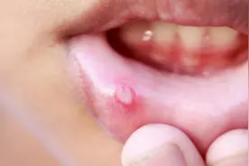 人为什么容易上火 爱吃辣只是原因之一图片