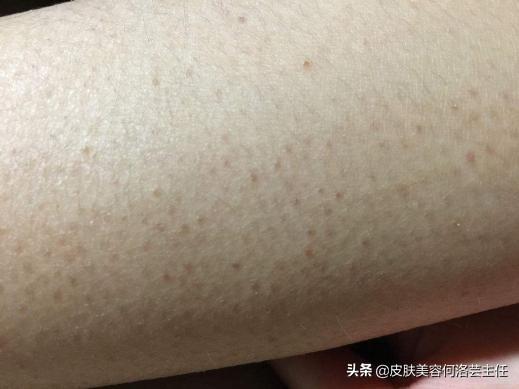 身上长鸡皮肤图片