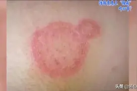 女白领每天撸猫 竟患上“猫病”图片