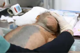 中国首例“猴子换头”手术，共耗资7000万，猴子后来怎样了？图片