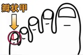 周围脚趾上的小趾甲分成两瓣的人，他们究竟什么特殊来历？图片