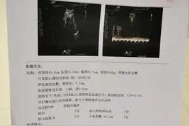 我的经历剖腹产详细过程，给各位即将生产的妈妈一个参考图片