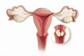 女性宫颈病变的患者，应选择手术治疗还是物理治疗？图片