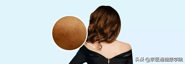 激光去鸡皮疙瘩