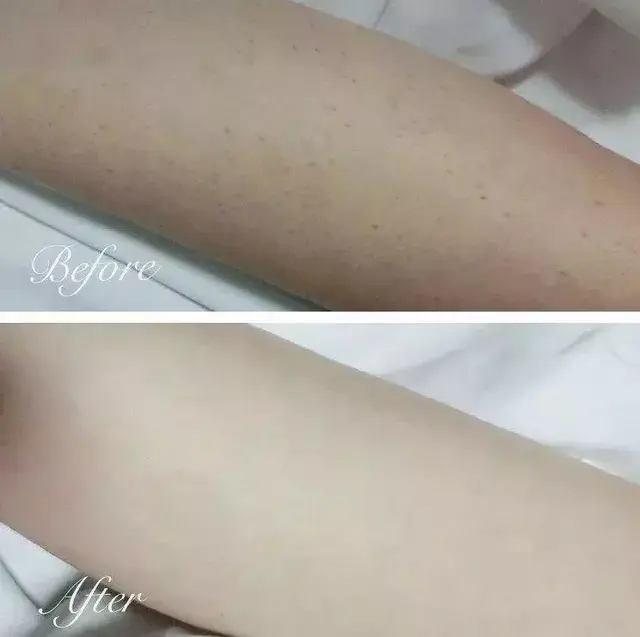 鸡皮肤治疗神器