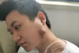 可怕！20多岁小伙智齿发炎，脸颊竟被脓肿穿破：里面全是脓液图片