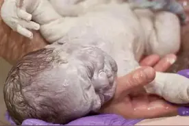 新生儿全身涂满“猪油”，母子相见吓坏产妇！医生：这是好事图片
