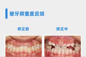 儿童牙齿矫正最佳年龄是什么时候？重点了解图片
