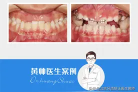 儿童牙齿矫正最佳年龄是什么时候？重点了解图片