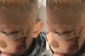 6岁男童保护妹妹被狗咬伤，获漫威英雄称赞，成为最小"荣誉拳王"图片