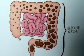 人体内真有6公斤宿便吗？怎么才能排出那些“赖着不走”的宿便？图片